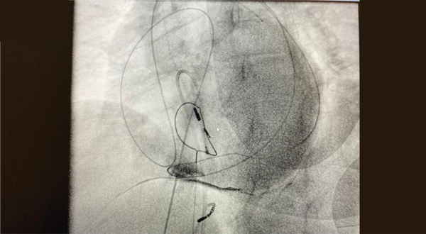 The right ventricular lead is out of heart silhouette under fluoroscopy.