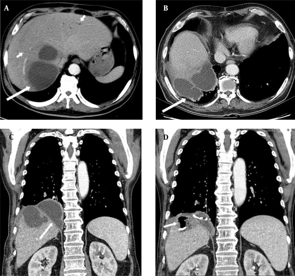 A 56-year-old man with a history of palliative cholecystectomy for cholangiocarcinoma, complaining of severe biliptysis. A, An axial abdominopelvic computed tomography (CT) scan revealing a large biloma (long arrow) in hepatic segments 7 and 8, with intrahepatic bile duct dilatation (short arrows) in both hepatic segments; B and C, Axial and coronal contrast-enhanced chest CT scans, revealing the increasing biloma extension into the right subphrenic space (arrow); D, The follow-up coronal contrast-enhanced chest CT scan revealing a further decrease in the size of biloma, air (arrow), and percutaneous catheter drainage tube in situ.