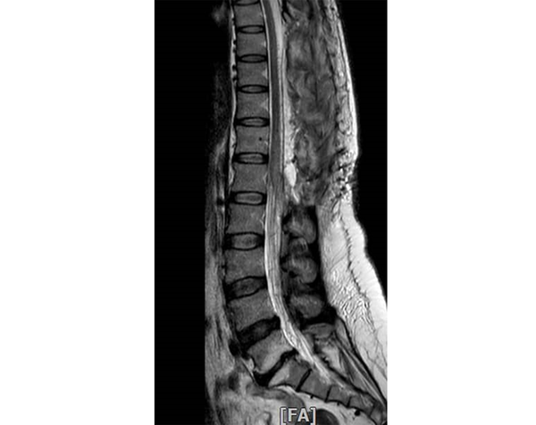 Sagittal T2-weighted MRI after laminectomy and embolization indicates diminished spinal cord edema and no signal voids