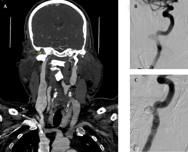 Pre- and post-treatment images of pseudoaneurysm. (A) CT angiography of the head and neck, indicating a PICA pseudoaneurysm; (B) Conventional angiography, indicating a pseudoaneurysm; (C) Conventional angiography indicating the obliteration of pseudoaneurysm.