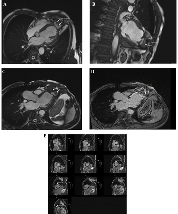 (A), (B), (C): Cardiac MRI cine SSFP images in long axis views showed large left ventricular (LV) apical pseudoaneurysm with a free communication with the LV cavity (depth: 46 mm, width: 60 mm), narrow orifice (5 mm), ruptured LV apical cap, septated LV apical outpouching surrounded by pericardial layers and included clot (arrow) in different sizes with extension of pseudoaneurysm over right ventricle (RV) apex with no evidence of communication into RV cavity; (D), (E): Late gadolinium enhanced CMR images detected thrombus (arrow) within the pseudoaneurysm and also demonstrated enhancement within the wall of the pseudoaneurysm and surrounding akinetic segments indicative of anterior MI (arrow head).