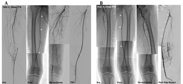 Cases of revascularization. A, A trans-Atlantic inter-society consensus document (TASC) C lesion in a 61-year-old male patient with 50-m claudication, treated with three Zilver PTX stents (arrowheads). About 10 months after the procedure, the patient complained of leg numbness, and the dorsalis pedis was not palpable. Revascularization was performed using drug-coated balloons and additional Zilver PTX stents. B, A TASC D lesion in an 83-year-old male patient with 20-m claudication and resting pain, treated with three Zilver PTX stents (arrowheads). During hospitalization after the procedure, the patient’s pain worsened, and revascularization for thrombotic total occlusion was performed. After nine months, he complained of toe color change; a femoropopliteal bypass (arrows) was performed for re-occlusion of the femoropopliteal artery.