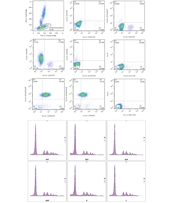 Dot-plot diagrams depict the immunophenotype characteristics of the abnormal lymphoid population. Additionally, serum protein immunofixation results confirmed the presence of monoclonal free lambda light chain.