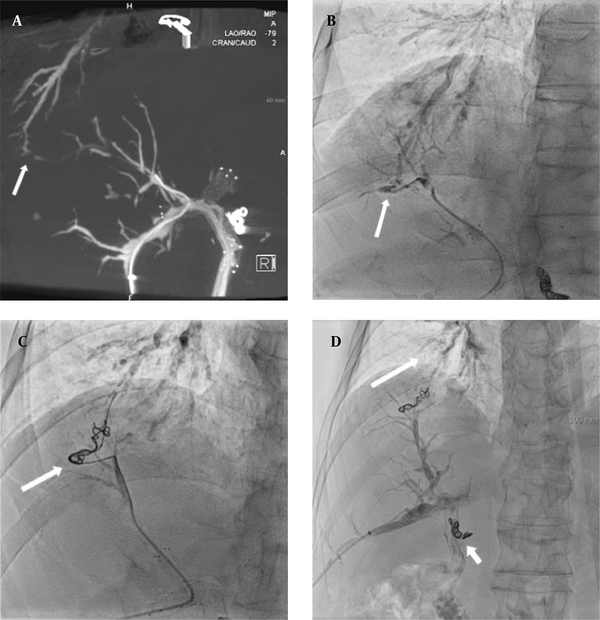 Percutaneous transhepatic cholangiography and the three-dimensional reconstruction image. A & B, A recanalized bronchobiliary fistula between the bile duct in hepatic segment 8 and the posterobasal segmental bronchus in the right lower lobe (arrows); C, Fluoroscopy obtained during embolization indicating microcoils in the fistulous tract (arrow), which were applied through a microcatheter. An additional embolization was performed using a mixture of n-butyl cyanoacrylate and lipiodol (not shown); D, The final cholangiography reveals no contrast medium passage into the bronchobiliary fistula or residual contrast medium in the right lower lobe segmental bronchus (long arrow). Another microcoil may be also observed around the proximal common bile duct due to prior embolization of a ruptured pseudoaneurysm of the gastroduodenal artery stump (short arrow).