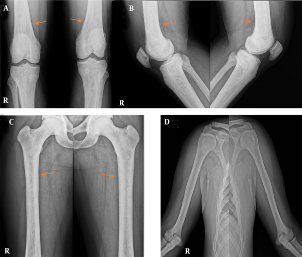 A-C, Tubular bone X-rays, indicating bilateral, symmetric metaphyseal, and diaphyseal sclerosis (arrows) of long tubular bones of the lower limbs; D, There is no sclerotic lesion in the long tubular bones of the upper limbs.