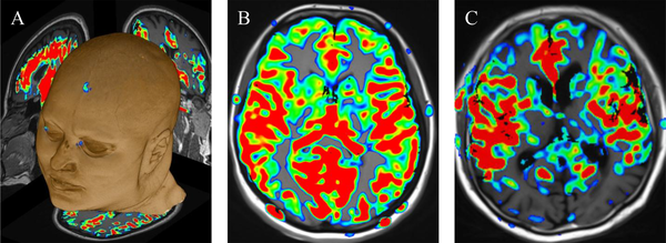 Cerebral blood flow (CBF) maps coregistered on Magnetization Prepared Rapid Acquisition Gradient Echo (MPRAGE) images; A, Using a Neuro 3D task on a Syngo platform; B, Normoperfusion in a depressed patient compared to; C, Hypoperfusion in the bilateral parietal lobes in an Alzheimer’s disease (AD) patient.