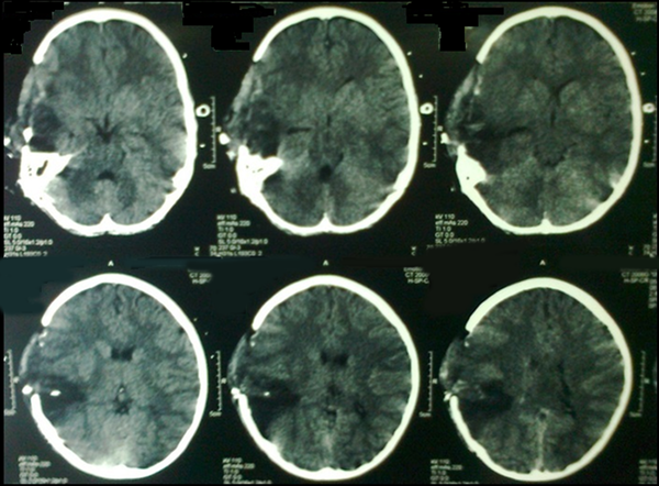 Postoperative brain CT scan of the patient with penetrating blast injury