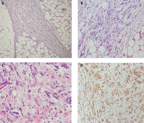 A, Infiltration of peritoneal fat by fibrosis and histiocytic cells (Haemotoxylin and Eosin [H&E] staining, × 200 magnification); B, Infiltration by fibrohistiocytic cells, lymphocytes, and several Touton giant cells (H&E staining, × 400 magnification); C, Sheets of foam cells with abundant cytoplasm (H&E staining, × 400 magnification); and D, CD68-stained macrophages (immunohistochemistry, × 200 magnification).