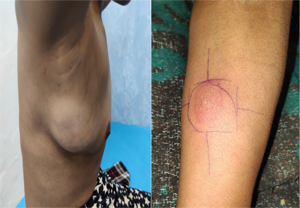 Lump in right breast in upper outer quadrant (left); Mantoux test: Positive after 48 hours (right)