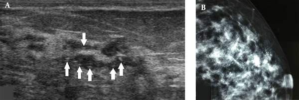 A, A 34-year-old patient with a misdiagnosis of ductal carcinoma in situ (DCIS). The ultrasound examination shows ductal dilations in the superior lateral quadrant of the left breast with poor ultrasound penetration and a weak echo pattern. There are scattered strong echogenic foci without acoustic shadowing (arrows), but with focal blood flow signals. The Breast Imaging-Reporting and Data System (BI-RADS) classification indicated a category 4A lesion, and the pathology report indicated intermediate-grade DCIS with microinvasions. B, Microcalcifications are found in the mammogram. The lesion was classified as BI-RADS 5.