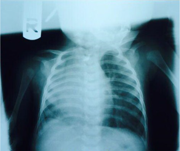 Initial chest X-Ray. Dextroposition of the heart and diffuse alveolar opacity in the right hemithorax.