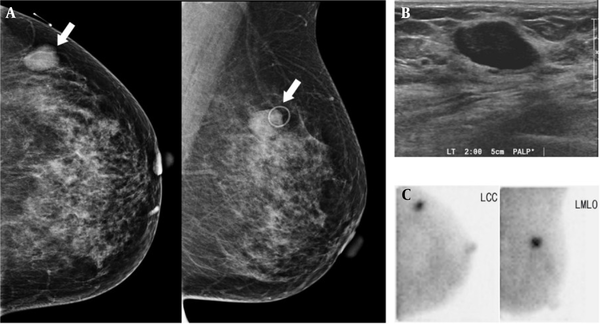A 42-year-old woman with a palpable mass in the left breast, which was diagnosed as fibroadenoma after surgery. The left craniocaudal (CC) and mediolateral oblique (MLO) images. A, show a circumscribed, oval-shaped, hyperdense mass (arrow) in the left upper outer quadrant. B, Breast US shows a circumscribed, oval-shaped, hypoechoic mass (2.3 cm) in the left breast (BI-RADS 4a). C, BSGI shows marked focal uptake in the left breast (BSGI, breast-specific gamma imaging; US, ultrasonography).