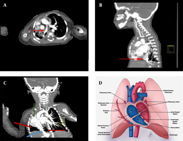(A) Chest computed tomography axial view; Red arrow showing a scimitar vein. (B) Chest, neck, and mediastinal computed tomography sagittal views showing dextrocardia, hypoplasia of the right upper lobe with severe hypoplasia of the right lower lobe; Red arrow showing a scimitar vein. (C) Chest, neck, and mediastinal computed tomography coronal views showing dextrocardia (green arrow), hypoplasia of the right upper lobe with severe hypoplasia of the right lower lobe (red arrows); Blue arrow showing a scimitar vein. (D) Several cardiac abnormalities related to scimitar syndrome: pulmonary vein stenosis, patent foramen ovale, partial absence of the pericardium, patent ductus arteriosus, atrial septal defect, and ventricular and septal defect (references: Arlene Sirajuddin, M.D., Bethesda MD, USA 2016)