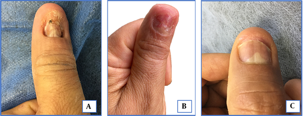 A, Hyperkeratotic and disappeared nail bed in the distal portion, adhered dystrophic nail plate in the central region, distorted lunula, and rounded fingertip; B, Day 3 after the procedure. Flattening of the nail bed and change in the morphology of the fingertip; C, Sixth months after the procedure. Considerable improvement in the shape of the nail and almost complete recovery of the nail bed and the shape of the fingertip. Triangular lunula can be observed.