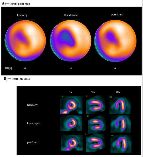 A typical serial imaging study. The myocardial images of a 71-year-old woman in early phase, delayed phase, and stress conditions using 99mTc-sestamibi (MIBI) single photon emission computed tomography (SPECT). The delayed phase images show severe 99mTc-MIBI washout in the septal regions of the left ventricle (LV).
