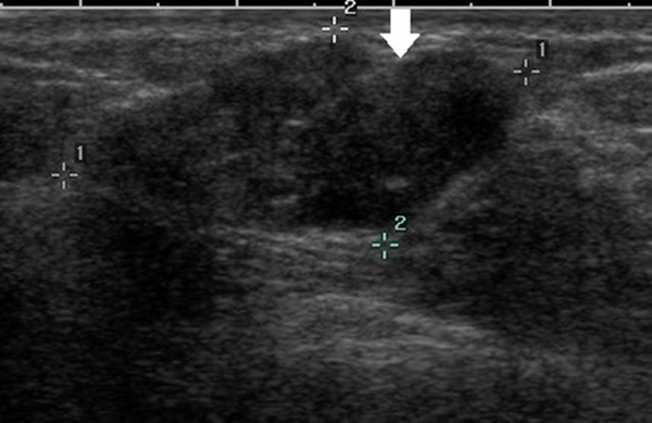 A 47-year-old patient with a misdiagnosis of ductal carcinoma in situ (DCIS). The ultrasound examination shows an occupying lesion in the inferior inner quadrant of the left breast with a parallel orientation, a large, lobulated, and oval shape (arrow), and circumscribed margins. Strong echogenic heterogeneous distributions are also detected. The Breast Imaging-Reporting and Data System (BI-RADS) classification indicated a BI-RADS 4A lesion, and the pathology report indicated high-grade DCIS with focal microinvasions.