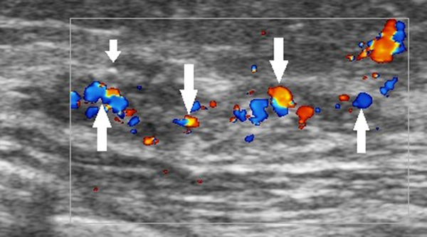 A 42-year-old patient with a definite diagnosis of ductal carcinoma in situ (DCIS). The ultrasound examination shows an occupying lesion in the superior lateral quadrant of the left breast, with multiple microcalcifications (short arrow) and abundant blood flow (long arrows) in the enlarged ducts. The Breast Imaging-Reporting and Data System (BI-RADS) classification indicated a 4C category, and the pathology report indicated a medium-to-high grade DCIS.