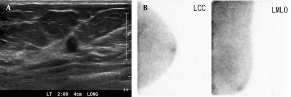 A 45-year-old woman with duct ectasia. Breast US. A, shows a small (7 mm) hypoechoic lesion with a taller-than-wide appearance in the left breast (BI-RADS 4a). B, BSGI indicates negative findings in the left breast (BSGI, breast-specific gamma imaging; US, ultrasonography).