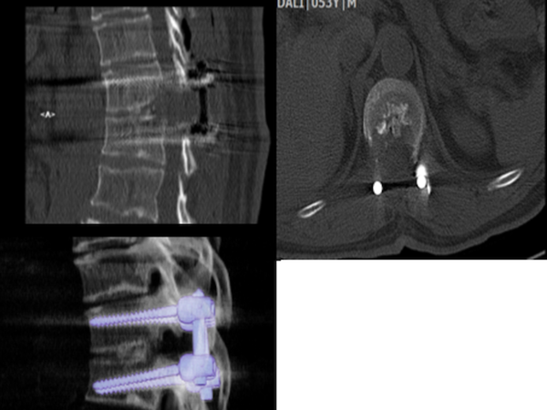 The postoperative images of the same patient in Figure 2. The right upper image shows the sagittal images of CT scan. The left image shows the axial CT scan of the patient and the removed calcified disc. The right lower image shows the pedicle screws and the removed disc.