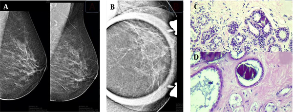 A sample of detected microcalcifications in a patient with benign lesions. Lesions can be seen on the mammogram in the mediolateral oblique (MLO) view (A) and magnification (B) view. In the pathological examination, a coarse heterogeneous microcalcification is associated with mild usual ductal hyperplasia (C) and a fibrotic background in the dilated ducts (D).