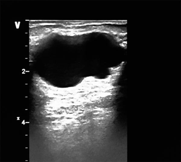 Simple breast cyst: Anechoic, thin-walled mass demonstrating posterior acoustic enhancement