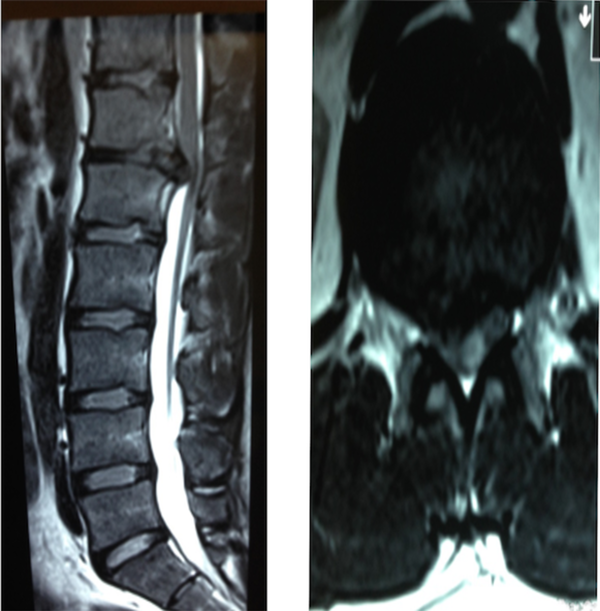 A 28-year-old male presented with right foot radiculopathy. Left image shows sagittal magnetic resonance imaging images of thoracic disc at level of T12 and L1. The right image shows axial images of thoracic disc herniation of the same patient.