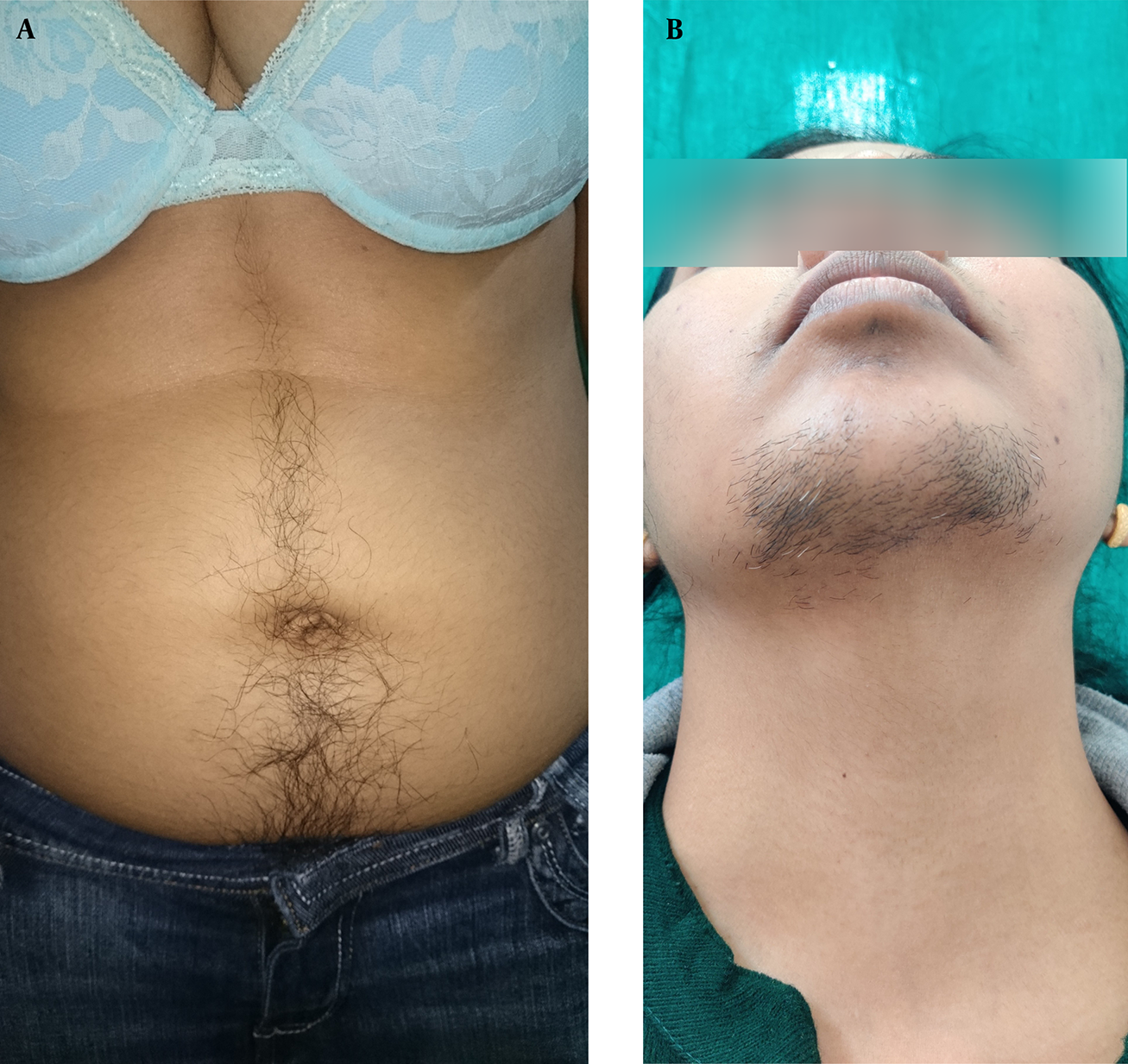A, Excess of terminal hair in androgen-dependent areas in a female over abdomen; B, Excess of terminal hair in androgen-dependent areas in a female over face.
