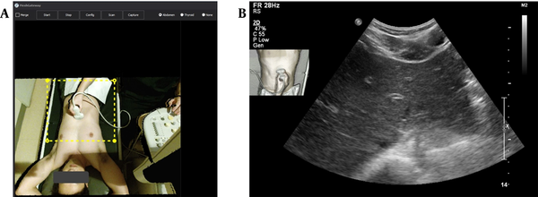 The ultrasound navigation convergence system (Mesh Gateway) work screen and the navigation-loaded ultrasound image transmitted to the picture archiving and communication system (PACS). A, The image acquired by the three-dimensional depth camera, installed on the participant's head, is transmitted to the Mesh Gateway system and appears on the work screen. Only the yellow dashed box is used for image fusion, which can be adjusted according to the patient's position or inspection site. B, A navigation-loaded ultrasound image taken by a transverse scan of the left hemi-liver. The top left side of the image shows a thumbnail containing information on the inspection site and transducer.
