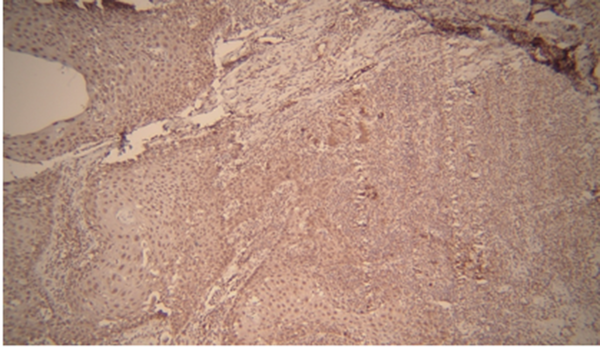 Matrix metalloproteinase-2 expression in verrucous carcinoma with 400X magnification