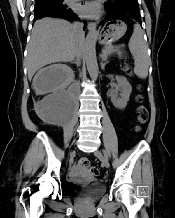 A 67-year-old woman presented with persistent cough, intermittent nausea, and progressive right flank pain for one month after ESWL. The CT scan of the abdomen indicates right perirenal and pararenal hematoma, measuring 12.8 × 9.4 cm along the right psoas muscle and the right paravertebral region after ESWL.