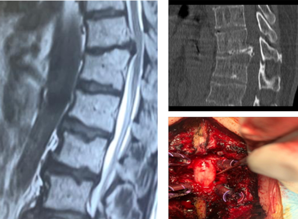 A 53-year-old patient presented with radiculopathy and myelopathy. The left image shows sagittal magnetic resonance imaging of the patient with T11 and T12 thoracic disc herniation. The right upper image shows the sagittal CT scan of the calcified disc. The right lower image shows the surgery site during the posterior transfacet discectomy (both facets are removed, and the curette shows the disc space).