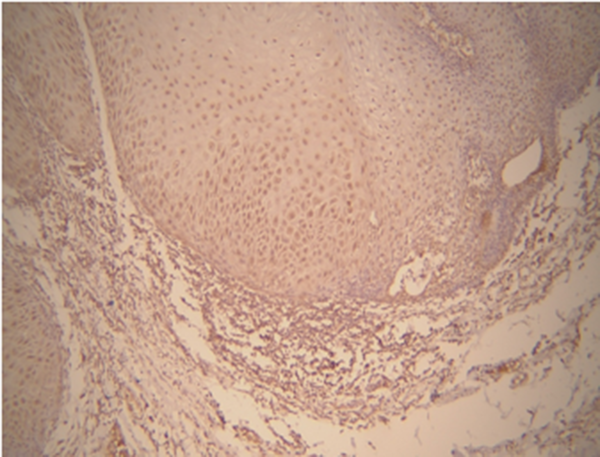 Matrix metalloproteinase-9 expression in verrucous carcinoma with 400X magnification