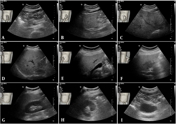 Application of body navigation-loaded ultrasound in the abdominal imaging of one of the participants. The A, pancreatic body, B-D, several hepatic regions, E, gallbladder, F, extrahepatic bile duct, G, right kidney, H, left kidney, and I, urinary bladder are shown in order. In addition to the imaged organs, there is information on the inspection site, transducer location, and transducer orientation. The final ultrasound in the middle row is an image of the extrahepatic bile duct (f, asterisk), indicating its acquisition in the left lateral decubitus position.