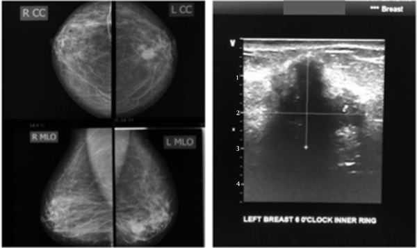 The LCC and LMLO views of the mammogram (left) show an oval dense, bilobed mass with spiculated margins extending into the surrounding tissues; complimentary ultrasound (right) shows a deeply hypoechoic, taller-than-wide mass with irregular margins. Findings are consistent with malignancy. Histology confirmed invasive ductal carcinoma.
