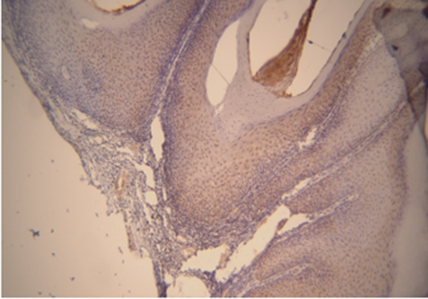 Matrix metalloproteinase-2 expression in oral squamous cell carcinoma with 400X magnification