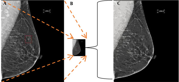 Mammogram resizing of convolutional neural network (CNN) input. A, Original mammogram with a size of 2560 × 3328; B, Resized mammogram with a size of 224 × 224; C, A magnified display of the resized image, showing blurred and destroyed calcification patterns.