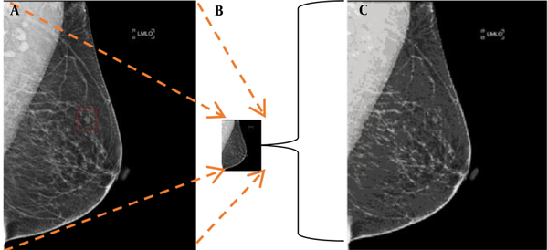 Mammographic microcalcifications and risk of breast cancer