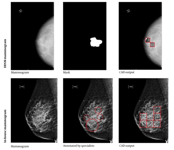 The performance of the patch learning approach (PLA) on two representative test mammograms from the digital database for screening mammography (DDSM) dataset (first row) and our in house dataset (second row). The middle column shows the annotations by specialists, and the third column shows the marked patches by the proposed computer-aided detection (CAD) system.