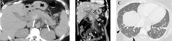A 43-year-old woman with epigastric pain for one week and a 10-day history of respiratory symptoms confirmed as COVID-19. A, The axial non-enhanced abdominopelvic CT scan shows a voluminous, highly attenuated thrombus in the main portal vein and splenic vein (white arrows). B, Coronal reformated contrast-enhanced abdominopelvic CT scan shows total occlusion, caused by an extensive acute thrombus in the portal and superior mesenteric veins (black arrows) with mesenteric perivascular edema (white arrowheads). C, Axial chest CT scan shows several subpleural lesions with ground glass attenuation in the right lower lobe (black arrowheads).