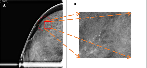 A, A calcification patch annotated in a mammogram; and B, A magnified lesion patch.