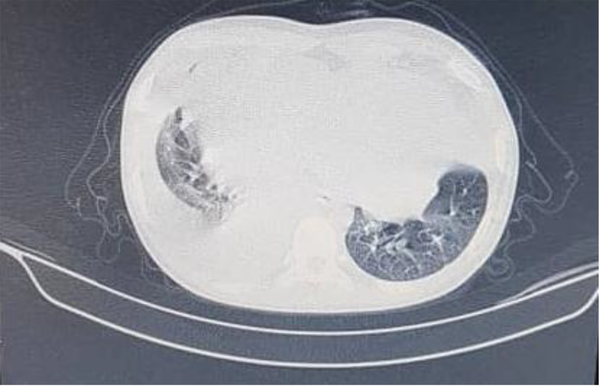 Spiral CT scan of the patient with right side pleural and huge pericardial effusion