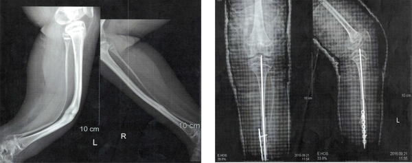X-ray radiographs X-ray of the patient's tibia and fibula bones