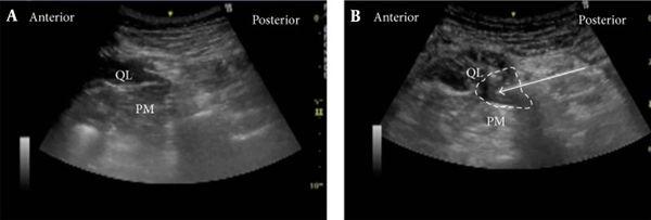 Ultrasound Images of anterior QLB. A, pre-injection; B, post-injection (50)