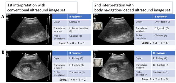 Ultrasound image interpretation and scoring. A, This case is evaluated in an oblique scan of the left hypochondriac region by identifying the spleen in the ultrasound image in the first interpretation. However, in the second interpretation, it was confirmed that the transducer is located in an epigastric region; therefore, reviewer B could accurately identify that the liver dome was captured by the ultrasound image. B, In the first interpretation of reviewer B, a transverse scan of the kidney was perceived; however, the left and right sides could not be distinguished; therefore, the score of the first interpretation was two. However, the second interpretation using body navigation-loaded ultrasound images shows that it is a transverse scan of the right kidney.