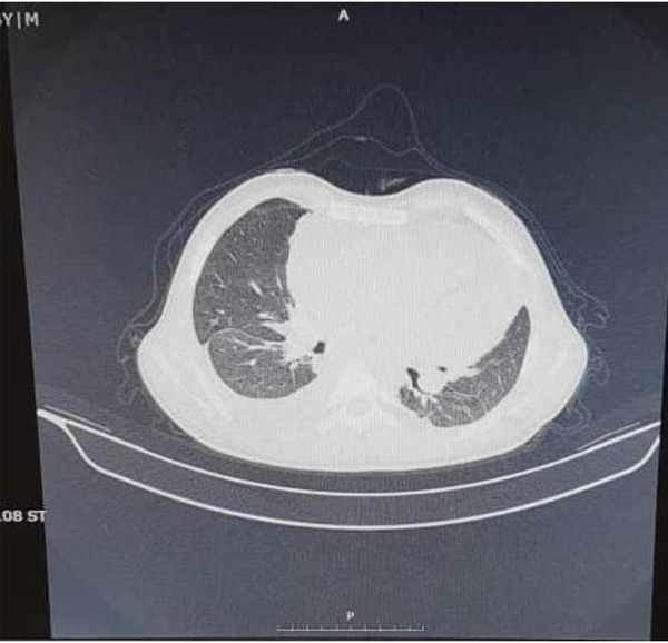 Spiral CT scan of the patient with enlarged heart view due to pericardial effusion and subpleural left lung consolidation in the upper lobe