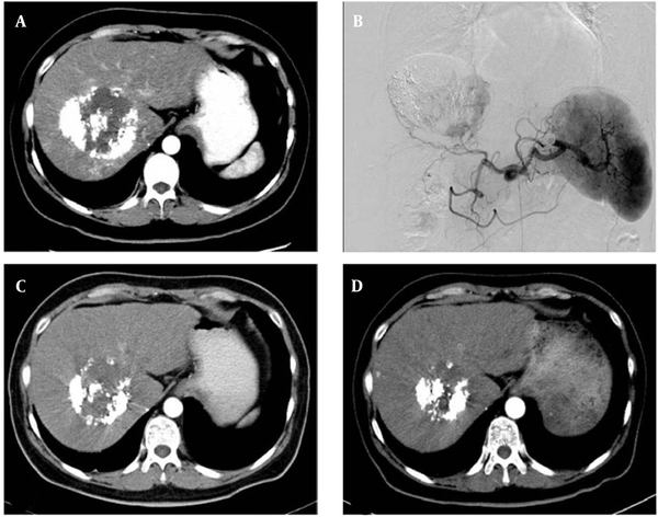The therapeutic effect of drug-eluting bead transarterial chemoembolization (DBE-TACE) procedure. A, A 48-year-old hepatocellular carcinoma female patient underwent conventional transarterial chemoembolization twice. Lipiodol accumulation can be seen in the tumor, and a patchy enhancement can be seen in the central and marginal areas of the tumor. B, Digital subtraction angiography confirms the CT signs in A. C, Six weeks after DBE-TACE, CT shows that the tumor size is significantly reduced, and only few light enhancement signs can be seen. D, Ten weeks after DBE-TACE, CT shows that the tumor size is further reduced, and there are no definite signs of enhancement in or around the tumor.