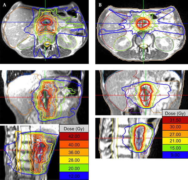 MRI-guided radiation therapy isodose lines with corresponding actual radiation dose. (A) The initial plan. (B) The adaptive boost plan.