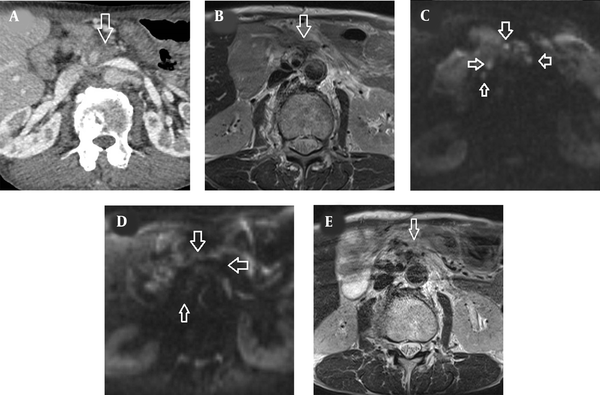 CT and MRI findings of locally recurrent pancreatic cancer. (A) Contrast-enhanced CT scan showed tumor lesions surrounding the superior mesenteric artery (arrow), which infiltrated the mesentery and the para-aortic region. (B) The recurrent lesion (arrow) was hyperintense relative to the adjacent muscles on T2-weighted MRI. (C) Diffusion-weighted image obtained with b factor of 800 s/mm2 showed multiple nodules (arrows) with high signal intensity compared with the spinal cord. (D) Three months after radiation therapy, there was no hyperintense tumor in the tumor bed and around the superior mesenteric artery on T2-weighted MRI (arrow). (E) Three months after radiation therapy, the multiple hyperintense nodules on diffusion-weighted image disappeared (arrows).