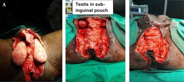 A, Wound after debridement and dressing; B, Wound after placing testis in sub-inguinal pouch; C, Wound defect after fixation to testis to the pouch.