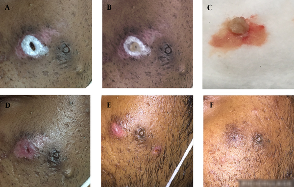 A - C, After drainage of the epidermoid cyst, cauterization with Trichloroacetic acid and removal of epithelial lining of the cyst after 1 week; and D, Healing of the cyst after 2 weeks; E, 3 weeks; and F, 4 weeks with good cosmetic result.